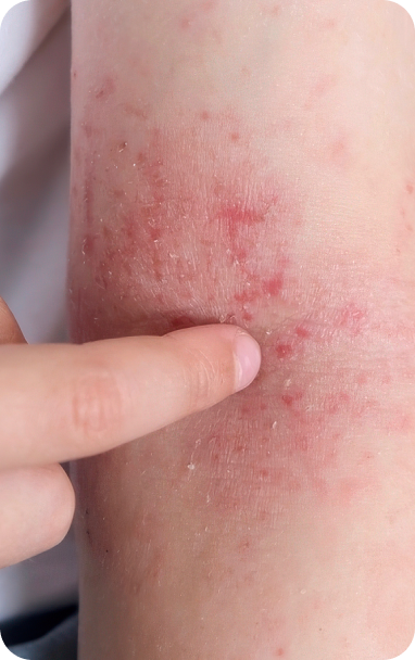 bibiotic derma helps